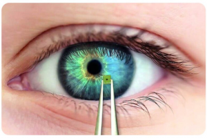 Де можна безоплатно встановити штучний кришталик: програма медичних гарантій