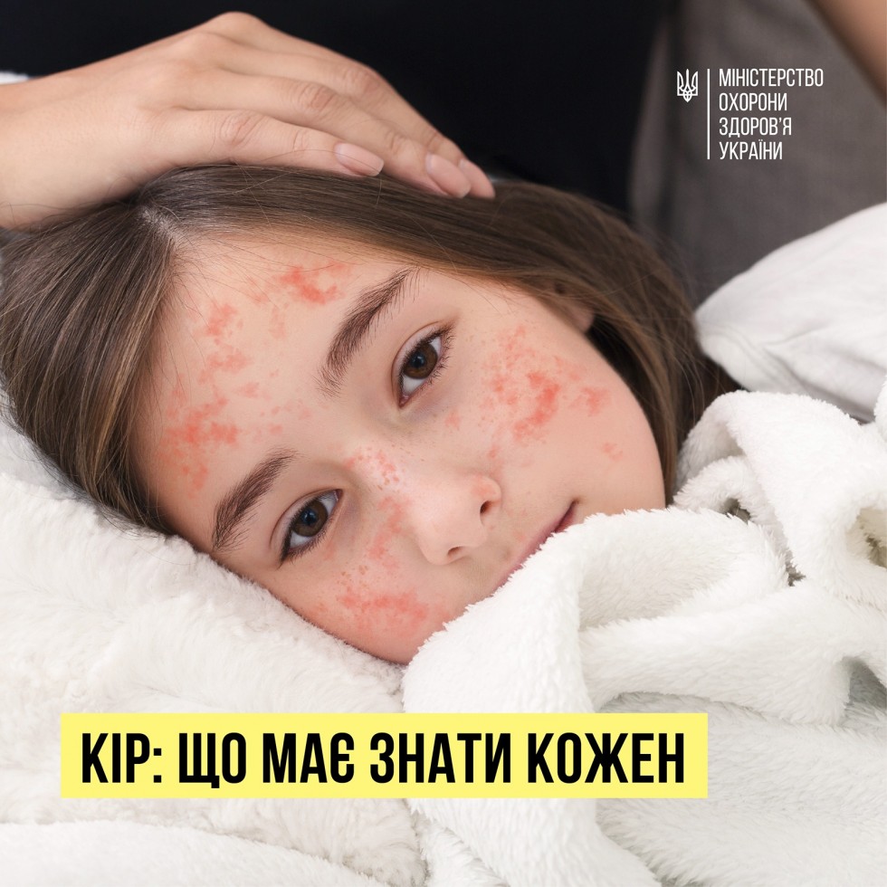 Кір - що має знати кожен? - МОЗ